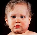 Bebeklerde Lenf Bezi Şişmesi Belirtileri ve Tedavisi