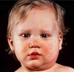 Bebeklerde Tükürük Bezi İltihabı Belirtileri ve Tedavisi Bebeklerde Tükürük Bezi İltihabı Belirtileri ve Tedavisi