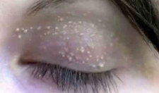 Küçük Yağ Bezesi Belirtileri ve Tedavisi Küçük Yağ Bezesi Belirtileri ve Tedavisi