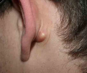 Kulak Arkası Beze Belirtileri ve Tedavisi Kulak Arkası Beze Belirtileri ve Tedavisi