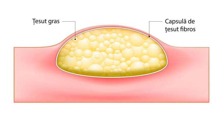 Yağ Bezesi Koku Yapar mı?